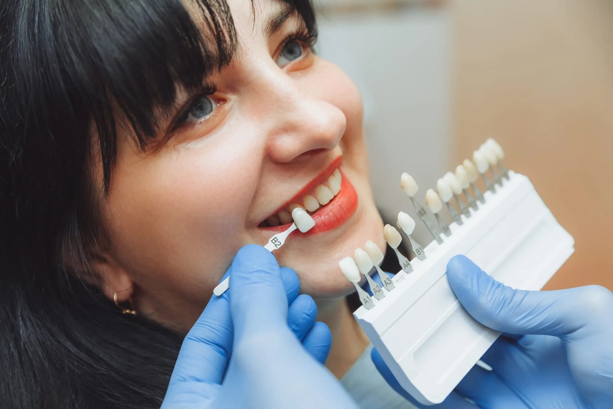 Smile transformation with porcelain veneers at Royal Oak Smiles NW Calgary